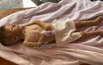 وفاة الطفل سيف حلس جوعًا في مدينة غزة  (فيديو)