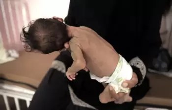 7 حالات وفاة في غزة جرَّاء سوء التغذية والمجاعة