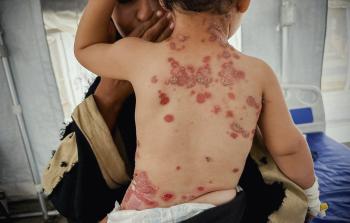 70% من عائلات غزَّة بلا صابون ولا مطهِّرات... كارثة صحِّيَّة تلوح بالأفق