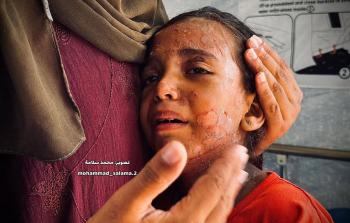 أزمة صحِّيَّة للأطفال في غزَّة.... الجدريُّ والجرب وانتشار الأمراض الجلديَّة