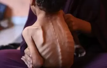 3 حالات وفاة نتيجة المجاعة وسوء التغذية في غزَّة خلال الـ 24 ساعة الماضية