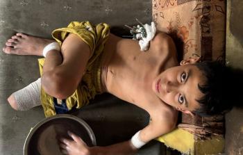 سمير زقوت.. طفلٌ قَطعت مُسيَّرة انتحارية أحلامه وأطرافه