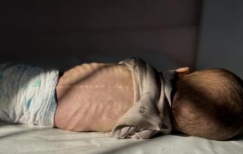 3 حالات وفاة جديدة جرَّاء سوء التغذية والمجاعة في غزَّة