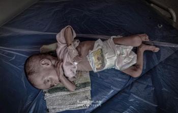 وفاة 3 أطفال في غزة بسبب سوء التغذية ونقص العلاج