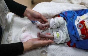 ارتفاع حصيلة وفيات سوء التغذية في غزَّة إلى 399 شهيدًا