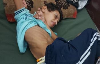 شظايا صاروخ أطلقه الاحتلال اخترقت رأس يوسف فأقعدته عن الحركة بالكامل