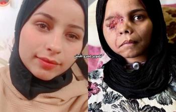 معاناة الجريحة ندى أرحومة في ظل نقص العلاج ومنع الاحتلال سفر الجرحى لتلقي العلاج