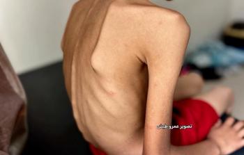 الطفلة بيان صقر تعاني من سوء التغذية جراء تفشي المجاعة وشح المواد الغذائية