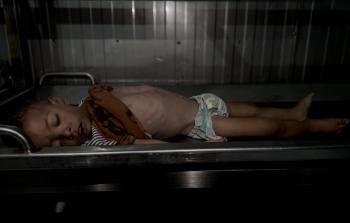 غزة مرض غيلان باريه