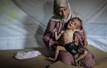 طفل يعاني من سوء التغذية في غزة