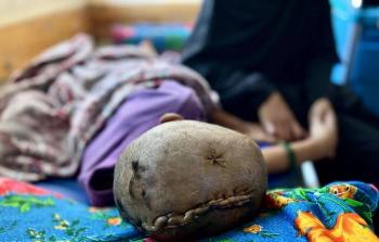 الطفل ساهر أبو عزوم يعاني من إصابة خطيرة أقعدته عن الحركة