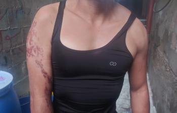 عماد أصيب بجرح بالغ في يده أفقده القدرة على ممارسة كمال الأجسام