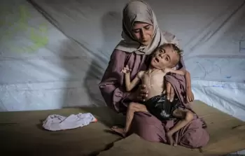 طفل يعاني من سوء التغذية في غزة (أرشيفية)