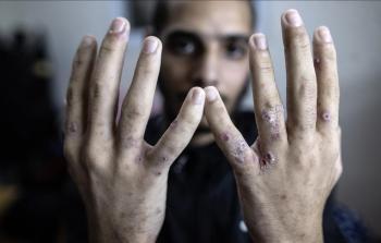 تفاقم انتشار مرض السكايبوس بين الأسرى الفلسطينيين في سجون الاحتلال