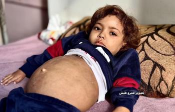 طفلة تواجه الموت بصمت وسط انهيار الرعاية الصحية في غزة