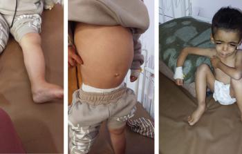 الطفل ياسر عرفات يعاني من سوء تغذية شديد ونقص خطير في الألبومين والبروتين