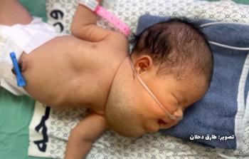 غياب الإمكانيات الطبية يجعل الأطباء عاجزين عن تحديد طبيعة التورم الذي تعاني منه الرضيعة حور قشطة