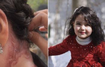 جلدها يحترق مرتين… شهد الباز طفلة تصارع الحروق والمجاعة في خيمة نزوح