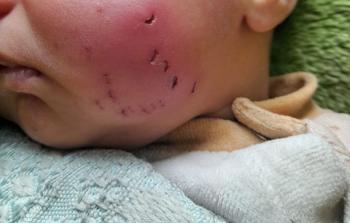 أثر عضة جرذ على وجه الطفل كريم