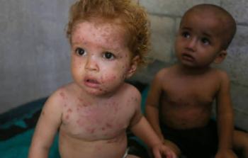 تحذيرات من تفشٍ واسع وسريع لجدري الماء داخل مخيمات ومراكز إيواء النازحين في غزة