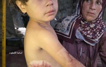 الطفلة إيلين العطار تعاني من حروق بعد سقوطها في طنجرة طعام مغلية أثناء هروبها من القصف