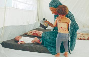 تسجيل أكثر من 58 ألف إصابة بجدري الماء منذ بداية عام 2026 في قطاع غزة