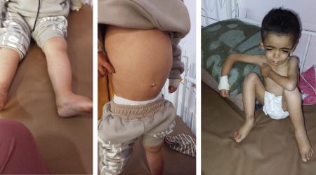 الطفل ياسر عرفات يعاني من سوء تغذية شديد ونقص خطير في الألبومين والبروتين