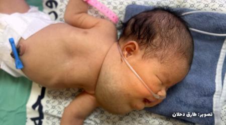 غياب الإمكانيات الطبية يجعل الأطباء عاجزين عن تحديد طبيعة التورم الذي تعاني منه الرضيعة حور قشطة