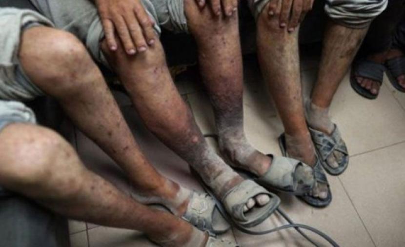 الجرب ينتشر بين الأسرى الفلسطينيين في السجون الإسرائيلية
