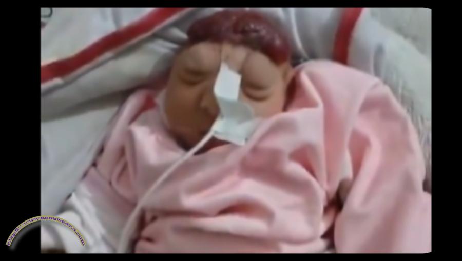 صورة ولادة طفلة بلا دماغ بغزة تثير صدمة مع تزايد حالات تشوه الأجنة